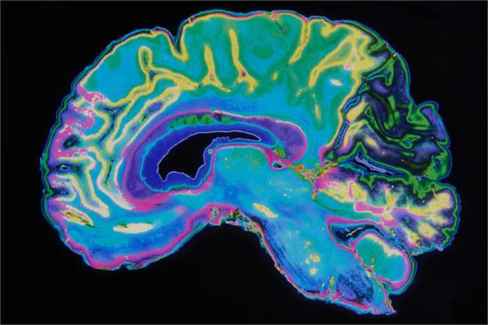 تشخیص  اسکیزوفرنی از جریان خون مغز با هوش مصنوعی آی بی ام